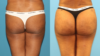 Tummy Tuck case #7348 slider thumbnail
