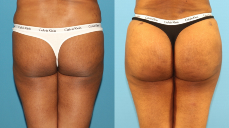 Tummy Tuck case #7348