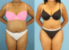 Tummy Tuck case #7348 slider thumbnail