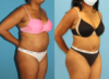 Tummy Tuck case #7348 slider thumbnail
