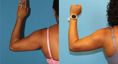 Tummy Tuck case #7348