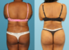 Tummy Tuck case #7348 slider thumbnail