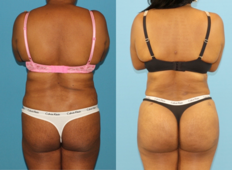 Tummy Tuck case #7348