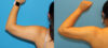 Liposuction case #6011 slider thumbnail