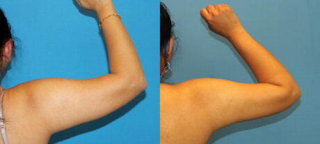 Liposuction case #6011