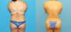 Liposuction case #6011 slider thumbnail