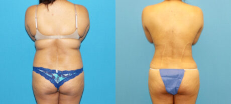 Liposuction case #6011