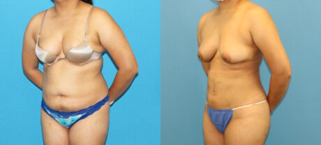 Liposuction case #6011