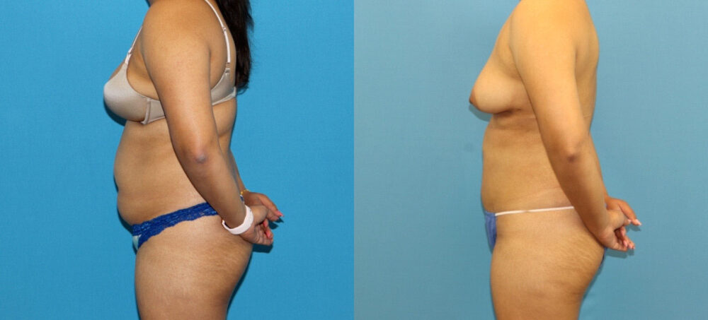 Liposuction case #6011