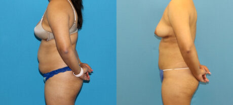 Liposuction case #6011