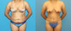Liposuction case #6011 slider thumbnail