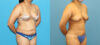 Liposuction case #6011 slider thumbnail