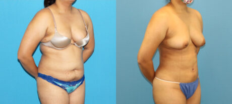 Liposuction case #6011