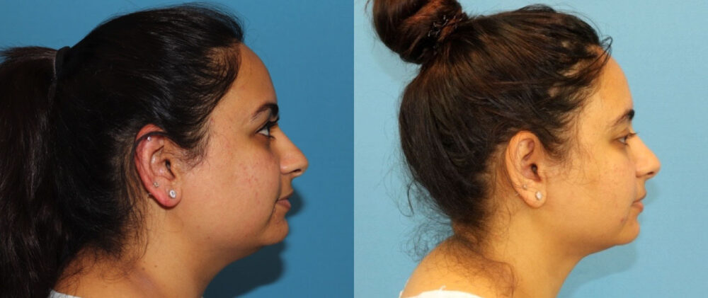 Submental Liposuction case #6946