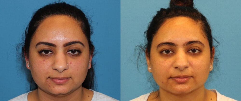 Submental Liposuction case #6946