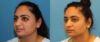 Submental Liposuction case #6946 slider thumbnail