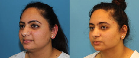 Submental Liposuction case #6946