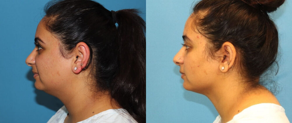 Submental Liposuction case #6946