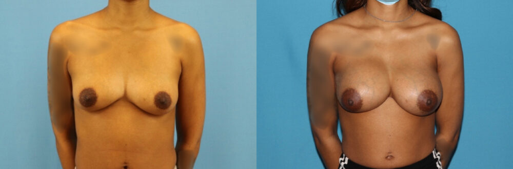 Breast Augmentation case #6346