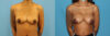 Breast Augmentation case #6346 slider thumbnail