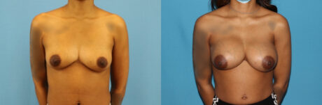 Breast Augmentation case #6346