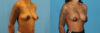 Breast Augmentation case #6346 slider thumbnail