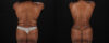 Mommy Makeover case #6688 slider thumbnail