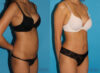 Tummy Tuck case #7231 slider thumbnail