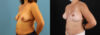 Mommy Makeover case #6520 slider thumbnail