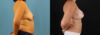 Mommy Makeover case #6520 slider thumbnail