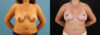 Mommy Makeover case #6520 slider thumbnail