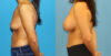 Breast Augmentation case #6352 slider thumbnail