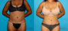 Tummy Tuck case #7230 slider thumbnail