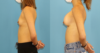 Breast Augmentation case #6358 slider thumbnail