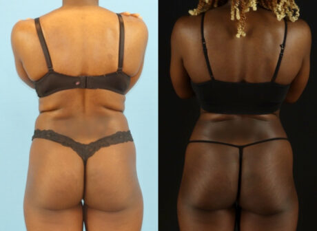 Liposuction case #6012