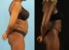 Liposuction case #6012 slider thumbnail