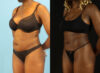 Liposuction case #6012 slider thumbnail
