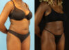 Liposuction case #6012 slider thumbnail
