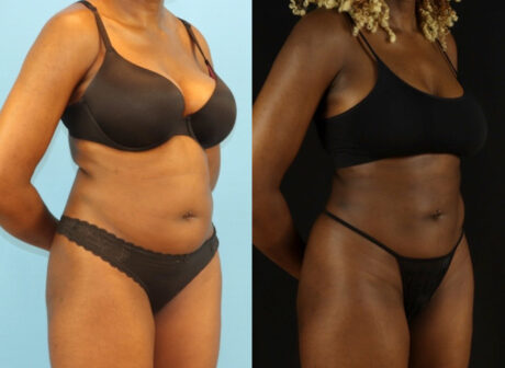 Liposuction case #6012