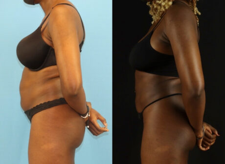 Liposuction case #6012