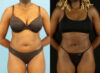 Liposuction case #6012 slider thumbnail