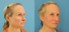 Profound RF Skin Tightening case #6906 slider thumbnail