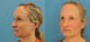Profound RF Skin Tightening case #6906 slider thumbnail