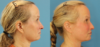 Profound RF Skin Tightening case #6906 slider thumbnail