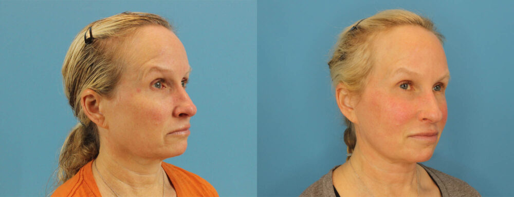 Profound RF Skin Tightening case #6906