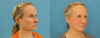 Profound RF Skin Tightening case #6906 slider thumbnail