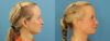 Profound RF Skin Tightening case #6906 slider thumbnail
