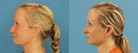 Profound RF Skin Tightening case #6906