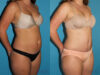 Tummy Tuck case #7229 slider thumbnail