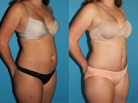 Tummy Tuck case #7229